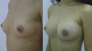 Mamoplastia - Cirugia Plastica La Paz