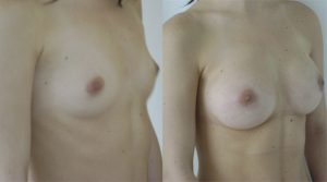 Mamoplastia - Cirugia Plastica La Paz