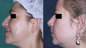 Lifting Facial - Cirugia Plastica La Paz
